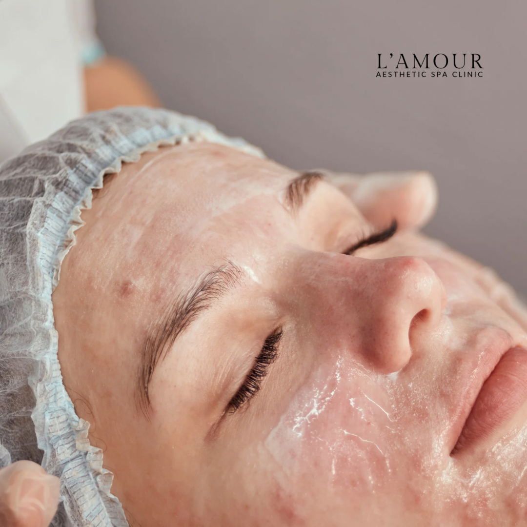 Acne treatment 45 min